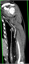 Diseased Brachial Artery - CTisus CT Scan