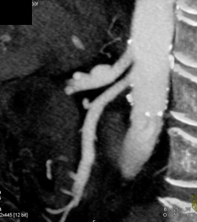 Celiac Artery Aneurysm- Incidental - CTisus CT Scan