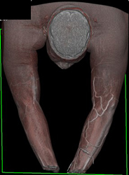 CTA Arm in Various 3D Perspectives - CTisus CT Scan