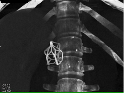 Inferior Vena Cava (IVC) Filter - CTisus CT Scan