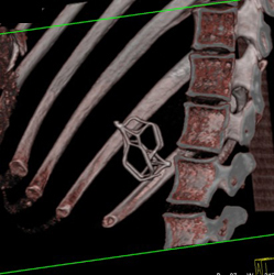 Inferior Vena Cava (IVC) Filter - CTisus CT Scan