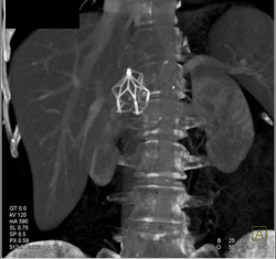 Inferior Vena Cava (IVC) Filter - CTisus CT Scan