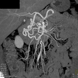 Celiac Stenosis Due to Median Arcuate Ligament Syndrome (MALS) and Collaterals - CTisus CT Scan