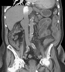 Poor Visualization of Inferior Vena Cava (IVC) - CTisus CT Scan