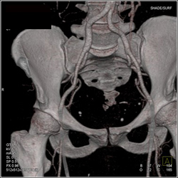 Gluteal Perforators Mapping for Breast Surgery - CTisus CT Scan