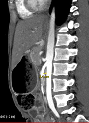 Superior Mesenteric Artery (SMA) Syndrome With Obstruction of Duodenum - CTisus CT Scan