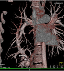 Scimtar Sign With Pulmonary Vein Draining Into the IVC - CTisus CT Scan