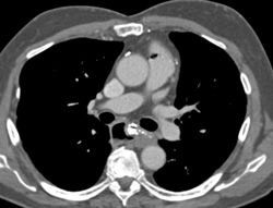 Air in Pulmary Artery - CTisus CT Scan