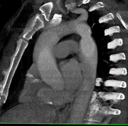 Coarctation of the Aorta - CTisus CT Scan