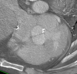 Bicuspid Valve - CTisus CT Scan