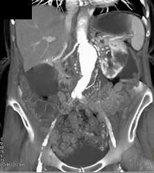 Aortic Aneurysm - CTisus CT Scan