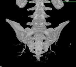 Gluteal Artery With Gluteal Flap Planning - CTisus CT Scan