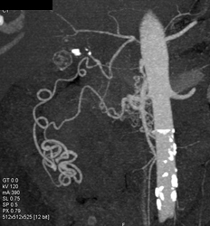 Collaterals Due to Celiac Stenosis - CTisus CT Scan