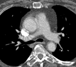 Pseudodissection Ascending Aorta - CTisus CT Scan