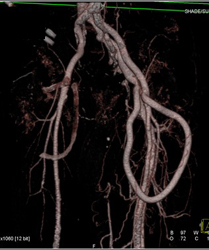 Av Shunt for Dialysis With Bone Removal - CTisus CT Scan