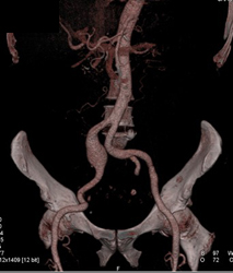 Iliac Artery Aneurysm - CTisus CT Scan