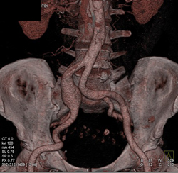 Iliac Artery Aneurysm - CTisus CT Scan