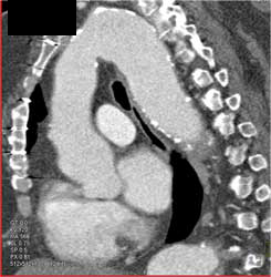 Ectatic Aorta With Aneurysm - CTisus CT Scan