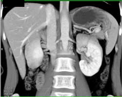 Splenic Artery Aneurysm - CTisus CT Scan