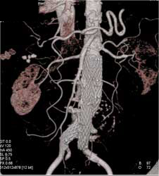 Stent in Abdominal Aorta - CTisus CT Scan