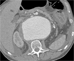 Huge Abdominal Aneurysm - CTisus CT Scan