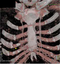 Internal Mammary Arteries - CTisus CT Scan