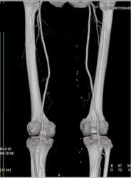 Normal Superficial Femoral Artery (SFA) - CTisus CT Scan