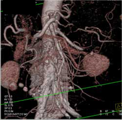 Vascular Map of Mesenteric Vessels - CTisus CT Scan