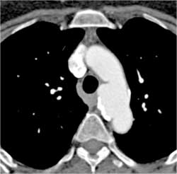 Ductus Aneurysm - CTisus CT Scan