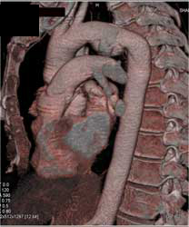 Ductus Aneurysm - CTisus CT Scan