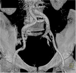 Iliac Artery Disease - CTisus CT Scan