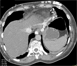 Collaterals in Abdominal Wall With Drainage to IVC - CTisus CT Scan