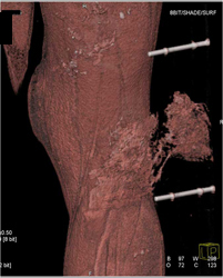 Injury to Superficial Femoral Artery (SFA) - CTisus CT Scan