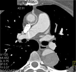 Type B Dissection - CTisus CT Scan