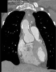 Type B Dissection - CTisus CT Scan