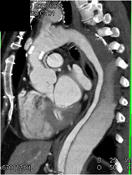 Type B Dissection - CTisus CT Scan