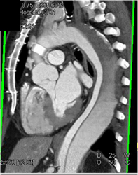 Type B Dissection - CTisus CT Scan