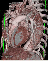 Repair of Ascending Aortic Aneurysm - CTisus CT Scan