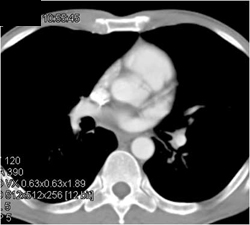 Pseudodissection of Aortic Root - CTisus CT Scan