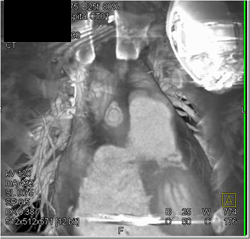 Focal Dilation at Origin of Bypass Graft - CTisus CT Scan