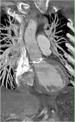 Aortic Valve Replacement - CTisus CT Scan