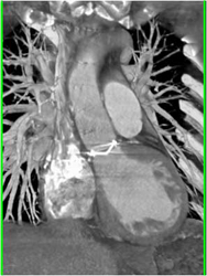 Aortic Valve Replacement - CTisus CT Scan