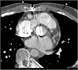 Aortic Valve Replacement - CTisus CT Scan