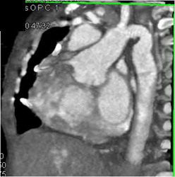 Coarctation of the Aorta With Dilation of Internal Mammary Artery - CTisus CT Scan