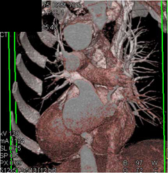 Aortic Aneurysm - CTisus CT Scan