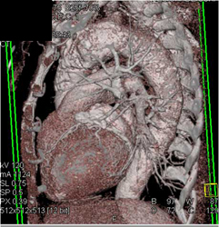 Aortic Aneurysm - CTisus CT Scan