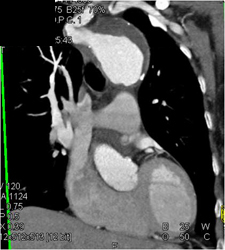 Aortic Aneurysm - CTisus CT Scan