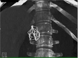 Inferior Vena Cava (IVC) Filter - CTisus CT Scan