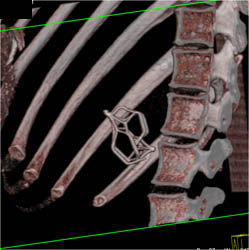 Inferior Vena Cava (IVC) Filter - CTisus CT Scan