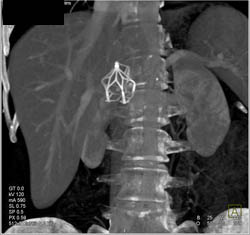 Inferior Vena Cava (IVC) Filter - CTisus CT Scan